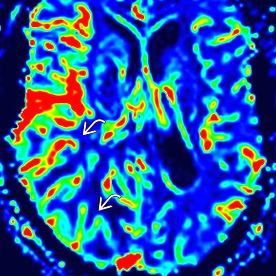 Axial rCBV map in the same patient shows increased CBV  in the right posterior cerebral hemisphere compared with the left. Cerebral hyperperfusion may occur after seizures, particularly with SE.