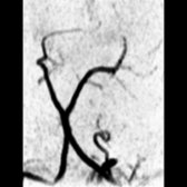 Coronal MRA in an infant with pituitary duplication demonstrates partial duplication of the upper basilar artery. Note that each superior cerebellar artery     arises from its "own" basilar artery.