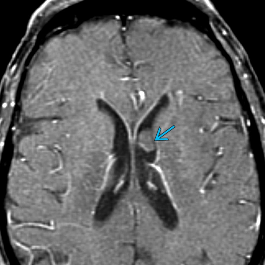 Axial T1 C+ FS MR in a 72-year-old man with declining mental state shows a nonenhancing mass  in the frontal horn of the left lateral ventricle. This is an incidental finding, most likely a subependymoma.