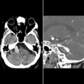 Axial NECT demonstrates a giant serpentine aneurysm in the basilar artery  with associated mural thrombus  seen on sagittal CTA.
