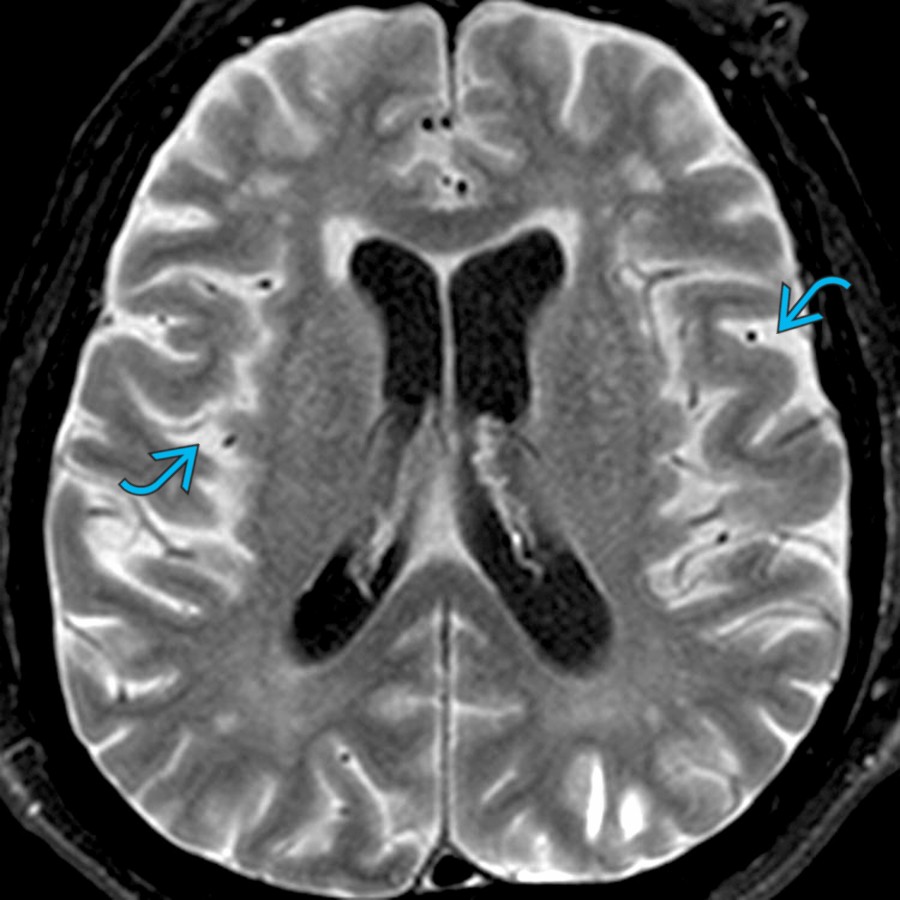 Axial FLAIR MR in a patient with chronic renal disease who received IV gadolinium 48 hours prior shows marked FLAIR hyperintensity  in the cortical sulci. Sulcal hyperintensity on FLAIR can be caused by pia-subarachnoid metastases, blood, protein (meningitis), high oxygen content, and retained contrast (renal failure, as in this case).