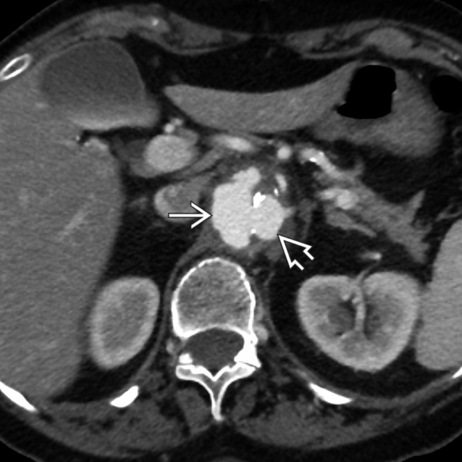 Axial CTA of the abdominal aorta shows a focal, eccentric pseudoaneurysm  affecting the juxtarenal abdominal aorta . Note the minimal periaortic soft tissue.