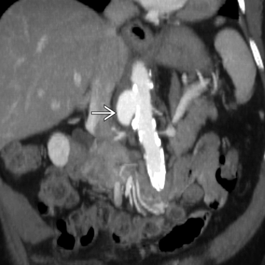 Oblique CTA of the abdominal aorta in the same patient shows a focal, eccentric pseudoaneurysm . There is no significant soft tissue adjacent to the pseudoaneurysm. This patient had bacteremia and spinal infection (not shown). Surgical resection of the aorta confirmed the mycotic nature of the pseudoaneurysm.