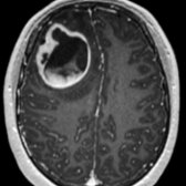 Axial T1 C+ MR shows a large right frontal mass with central cystic change . Supratentorial ependymomas are usually periventricular and are thought to arise from ependymal rests in the periventricular white matter.
