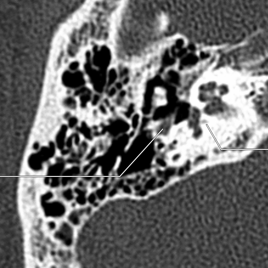 Third bone CT shows the posterior genu of the right facial nerve.
