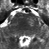 Axial T2WI MR in the same patient shows hyperintense signal in crossing CSTs in the left side of the pons , consistent with WaD.