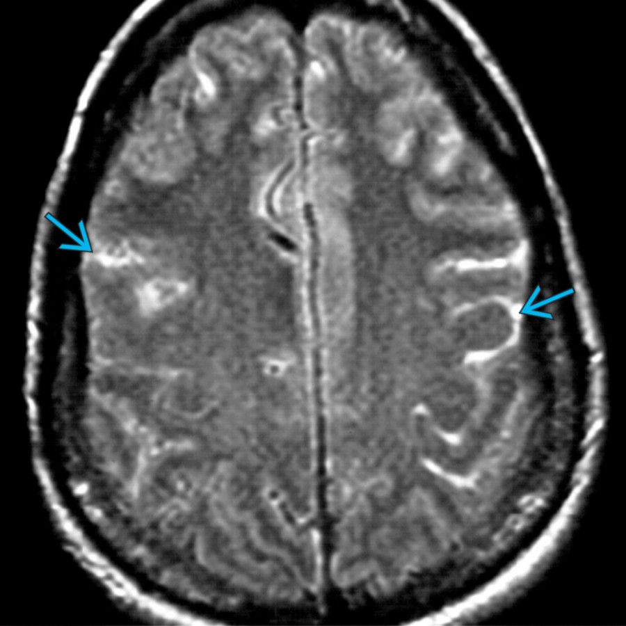 Axial FLAIR MR shows multifocal sulcal hyperintensities  caused by aneurysmal subarachnoid hemorrhage.