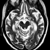 Axial T2 MR in a patient with AD shows enlarged temporal horns   and disproportionate volume loss in the temporal lobes  as compared to the normal-appearing occipital lobes .