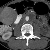 Axial CECT of the abdominal aorta shows periaortic, low-density soft tissue  with rim enhancement  of the aortic wall, which is consistent with an infected aortic wall and periaortic abscess.