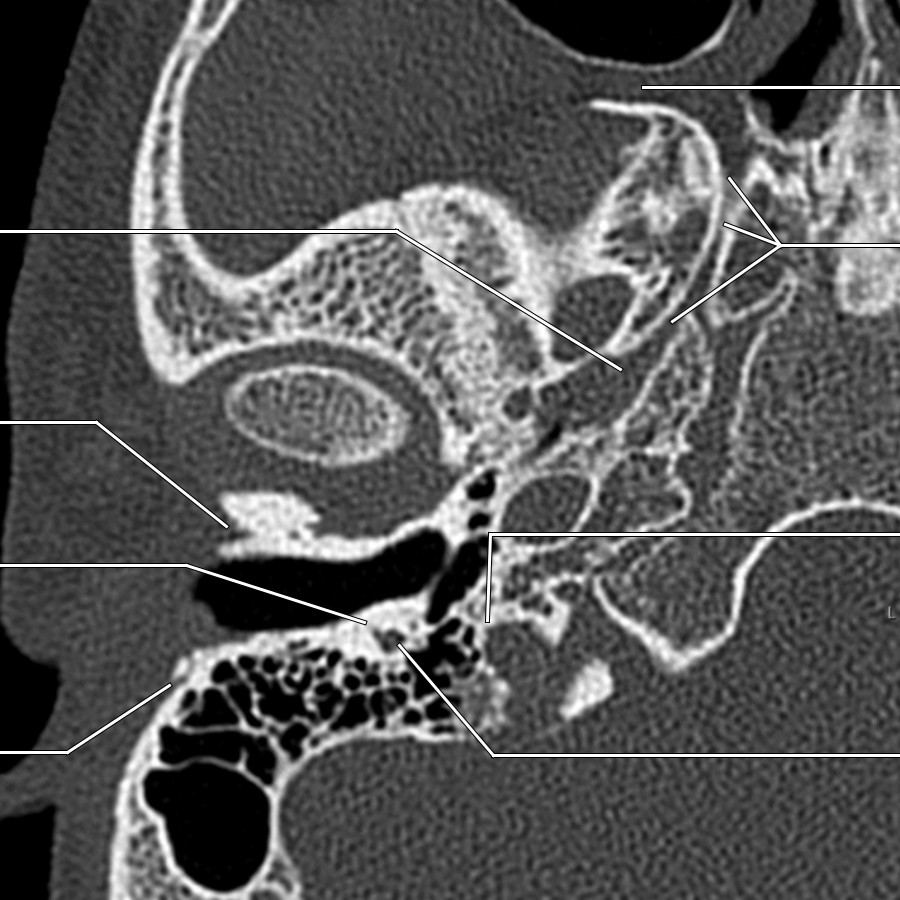 Chorda tympani nerve origin from the descending mastoid segment of the right facial nerve is shown.