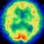 Tc-99m HMPAO SPECT in a 67-year-old woman with suspected AD shows decreased perfusion in bilateral parietal lobes . (Courtesy J. Singh, MD.)