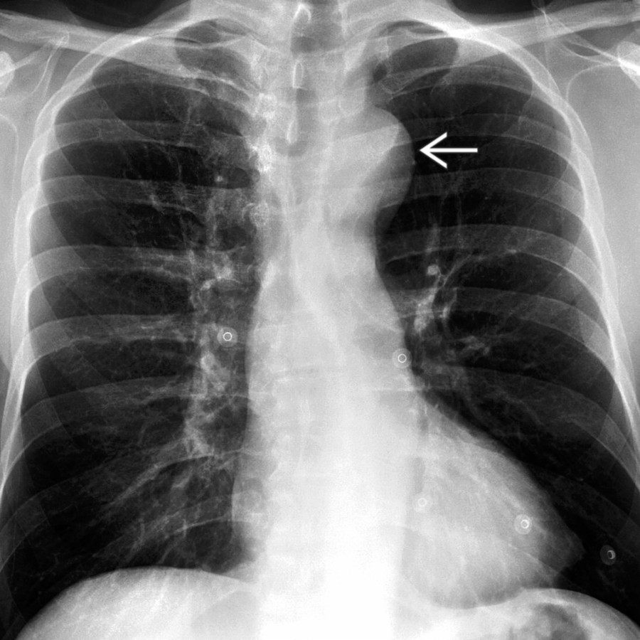 Posteroanterior chest radiograph shows a prominent and high-riding aortic arch . The normal heart size and absence of rib notching due to collateral vessels distinguish PCOA from coarctation of the aorta (COA).