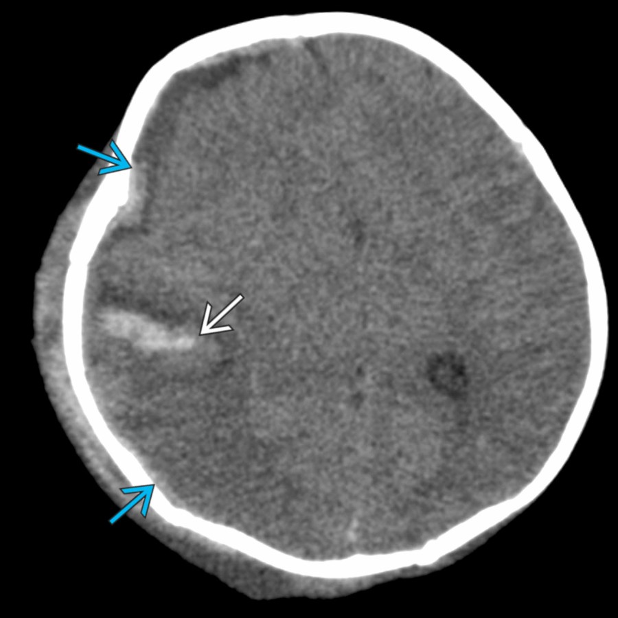 Axial NECT in the same 9-week-old shows a right subdural hematoma (SDH)  & right opercular parenchymal laceration  with significant midline shift & sulcal effacement. Parenchymal lacerations are seen in 10-15% of AHT patients.