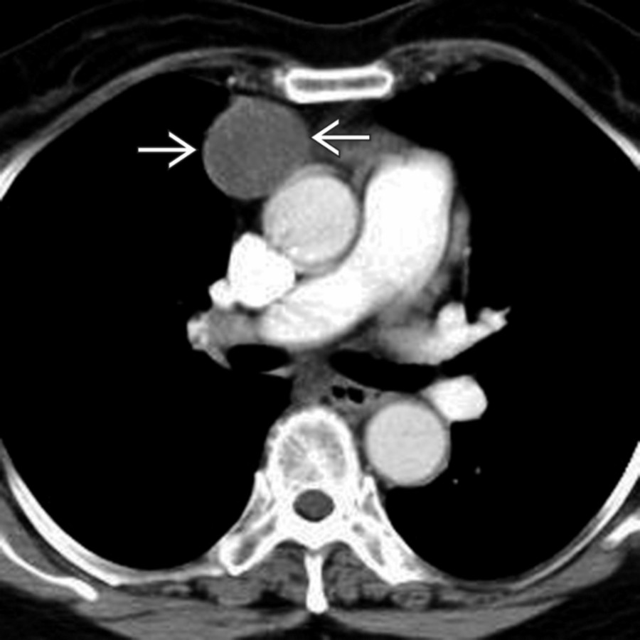 Axial CECT shows a pericardial cyst as a well-circumscribed, thin-walled fluid collection  adjacent to the right atrium without adjacent inflammatory stranding.