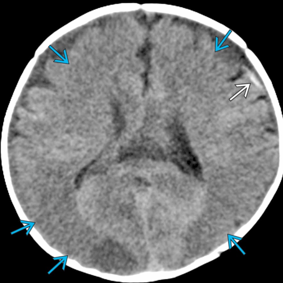 Axial NECT in a 4-month-old boy with seizure activity shows multiple bilateral foci of low attenuation with loss of cortical differentiation  as well as a left frontal SDH . There was no fracture, making these findings highly concerning for the shaking type of AHT.
