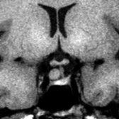 Coronal T1 MR in an asymptomatic patient shows a small, suprasellar mass  that is isointense with the brain clearly separate from the pituitary gland . The infundibular stalk is slightly deviated to the left. This was presumed to be a Rathke cleft cyst.