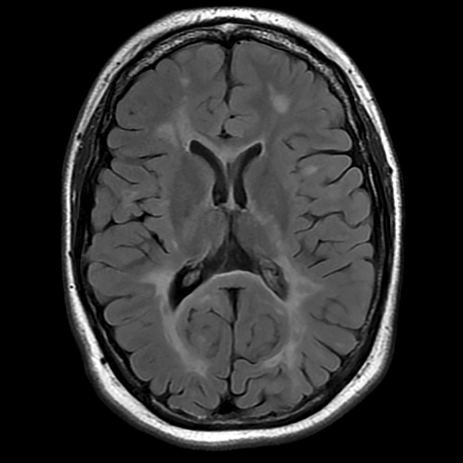 Axial FLAIR MR in the same patient reveals extensive bilateral white matter demyelinating lesions, predominately periventricular but also within more peripheral white matter. Mild diffuse white matter volume loss with passive ventricular enlargement is present.