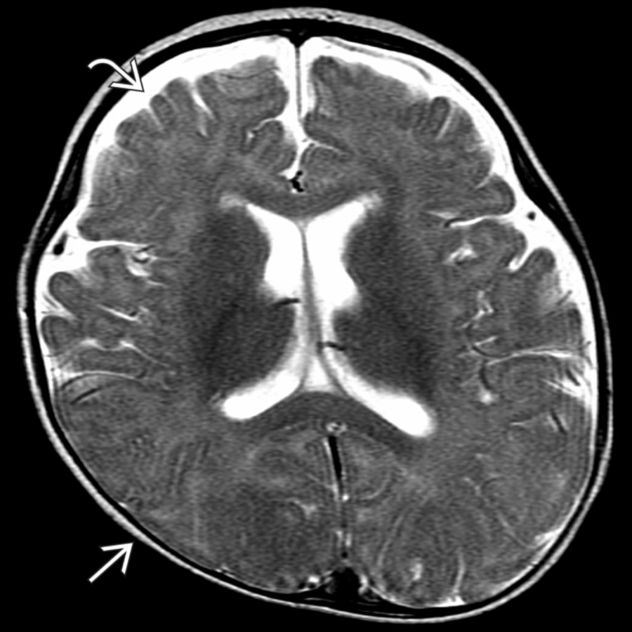 Axial T2 MR shows enlarged frontal & anterior interhemispheric pericerebral fluid spaces , mild ventriculomegaly, & right-sided posterior plagiocephaly  in a 7-month-old boy with macrocephaly.