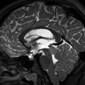 Sagittal T2 MR shows a T2-hyperintense mass  in the tectal plate obstructing the cerebral aqueduct. Despite the lack of biopsy, this is most commonly a low-grade diffuse glioma or tectal glioma. The course is generally indolent and commonly requires ventricular shunting.