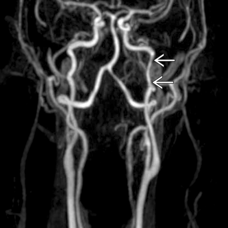 Coronal MRA appears nearly normal in this patient with distal cervical left ICA dissection. Note the mild smoothly marginated caliber change  that is easily missed until compared with the contralateral side. The ICAs, unlike the vertebral arteries, normally demonstrate a symmetric size in the neck.