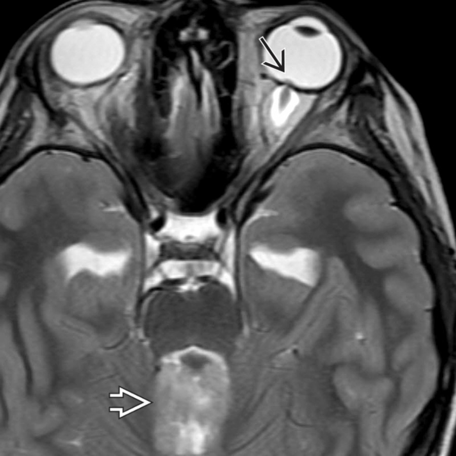 A medulloblastoma  fills and obstructs the 4th ventricle in this 10-year-old, leading to supratentorial ventriculomegaly and papilledema . Papilledema visible on MR typically correlates to grade 3 on the Frisen scale (moderate edema).