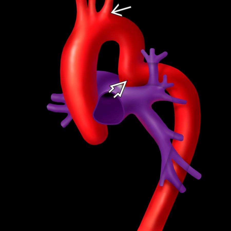 Coronal oblique graphic in a patient with pseudocoarctation of the aorta (PCOA) demonstrates an elongated, kinked, and buckled aortic arch  distal to the origin of left subclavian artery  at the level of the ductus arteriosus.
