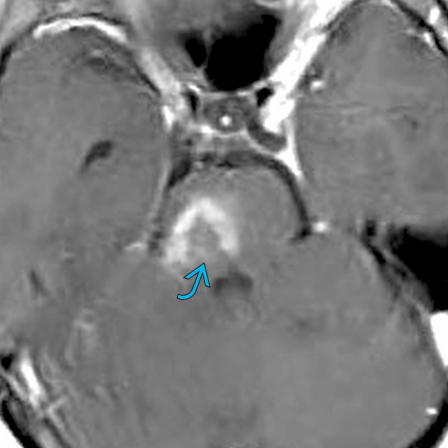 Axial T1 C+ MR demonstrates a typical incomplete ring of enhancement in tumefactive demyelination . Such lesions can present with variable degrees of mass effect. The incomplete ring of enhancement allows differentiation from neoplastic causes.