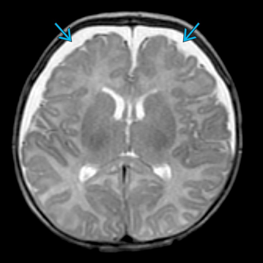 Axial T2WI in the same 1-month-old girl with AHT on day 2 shows significant enlargement of the extraaxial collections , most of which is nonhemorrhagic & isointense to CSF, consistent with a growing SDHy.