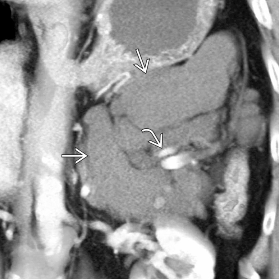 Coronal volume-rendered CECT demonstrates a multiloculated, cystic lesion  in the left retroperitoneum. The lesion envelops multiple arteries and veins , which do not appear deviated or narrowed.