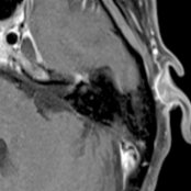 Axial T1 C+ FS MR in a patient with Bell palsy shows the classic faint, tuft-like enhancement at the fundus of the IAC , which extends as a linear enhancement along the labyrinthine segment , anterior genu , and anterior tympanic  segments of the facial nerve.