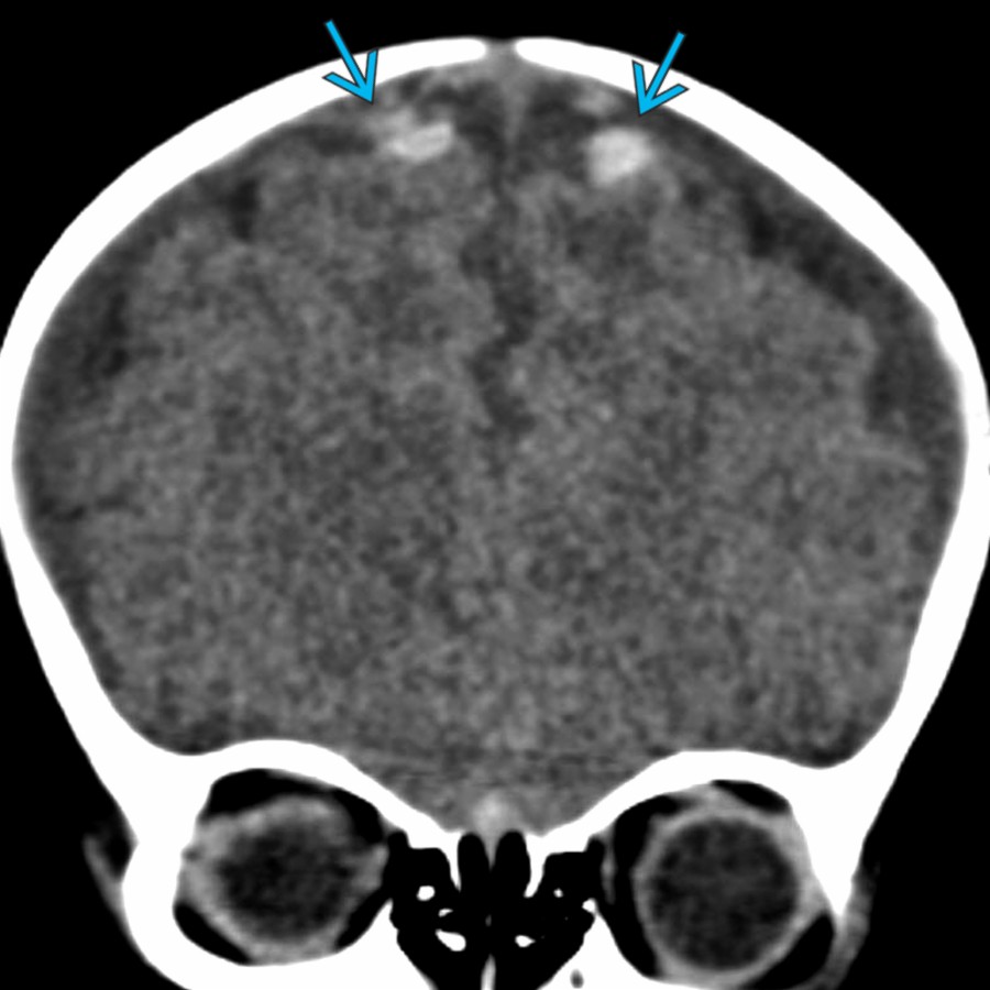 Initial coronal NECT in a 1-month-old girl with AHT shows bilateral paramedian extraaxial hemorrhages , a characteristic finding in AHT attributed to bridging vein injury & thrombosis. In all, 40-50% of AHT cases show evidence of bridging vein injury.