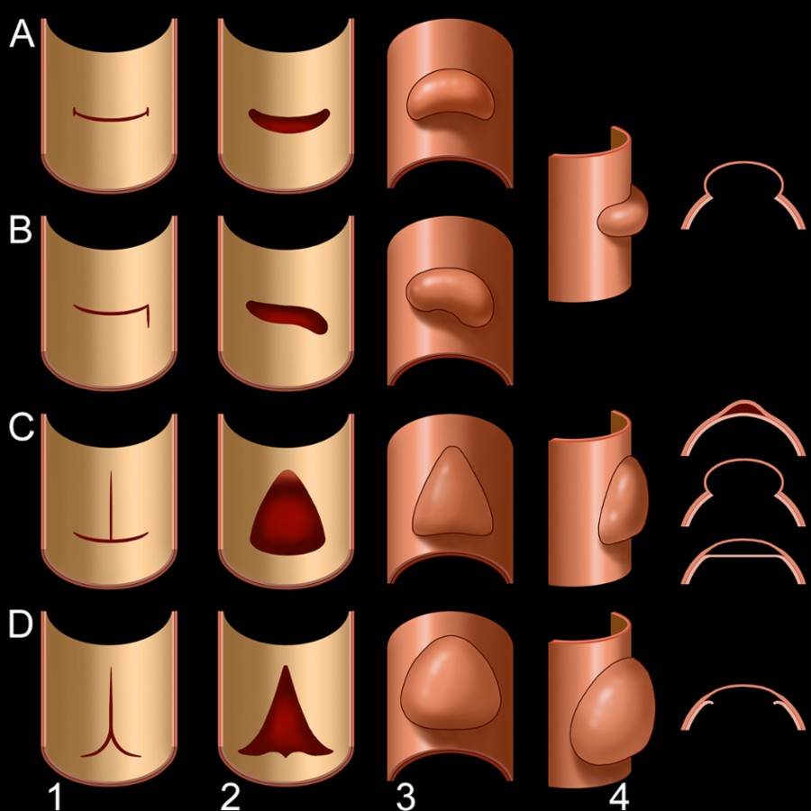 Schematic shows the luminal view of intimomedial tear shapes (column 1), their stretched open luminal appearance in a pressurized aorta (column 2), external bulges (column 3), and side view (column 4). Schematic also illustrates linear (A), L-shaped (B), T-shaped (C), and star/complex shaped (D) tears. (Courtesy Madani et al.)
