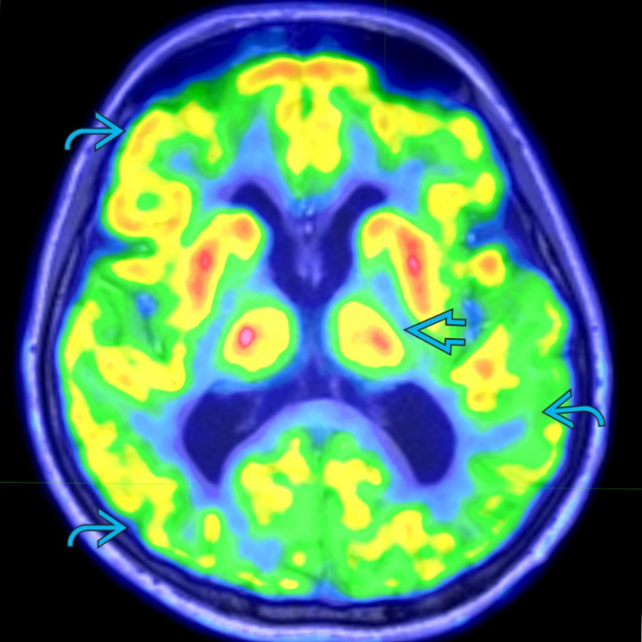 Axial fused F-18 FDG PET/CT in a patient with global encephalopathy with EEG reporting nonlateralizing and nonlocalizing seizures shows subtle bilateral regions of hypometabolism  and asymmetric decreased FDG uptake in the left thalamus , suggesting left lateralization.