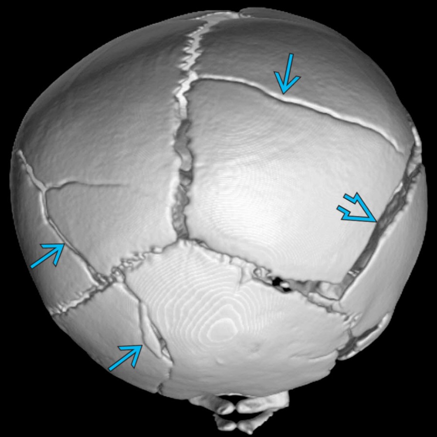 Posterior oblique view of a 3D NECT in a 9-week-old who "fell off the couch" shows multiple complex skull fractures , including a displaced right parietal fracture . 3D renderings are helpful in improving the detection & characterization of skull fractures.