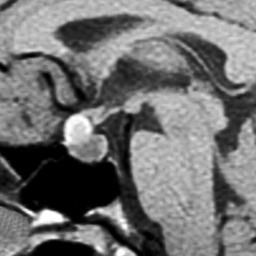 Sagittal T1 MR shows a suprasellar mass in a 35 year old with visual changes. The hyperintensity is atypical. Note the lack of a normal posterior "bright spot."
