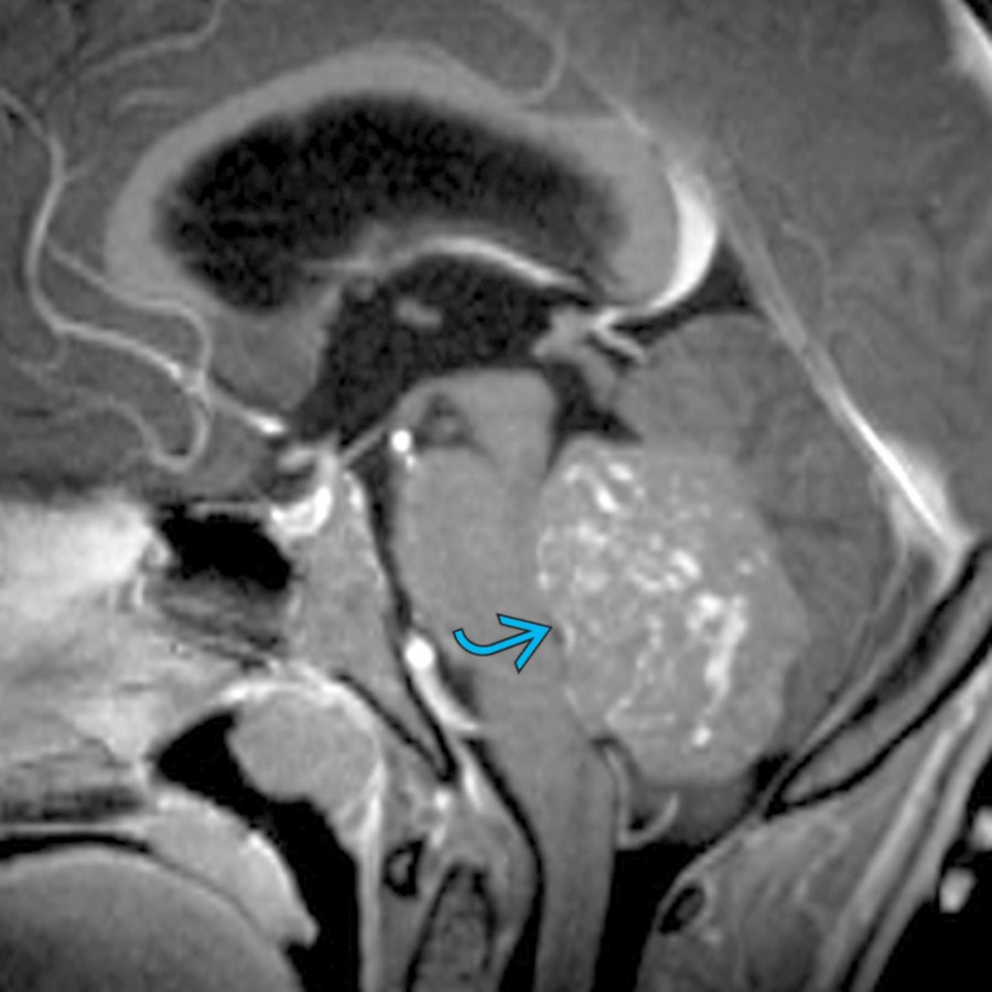 Sagittal T1 C+ MR in a 8-year-old child with ataxia demonstrates a large, heterogeneously enhancing mass  centered in the 4th ventricle. Pathology revealed a classic medulloblastoma, Wnt-activated.