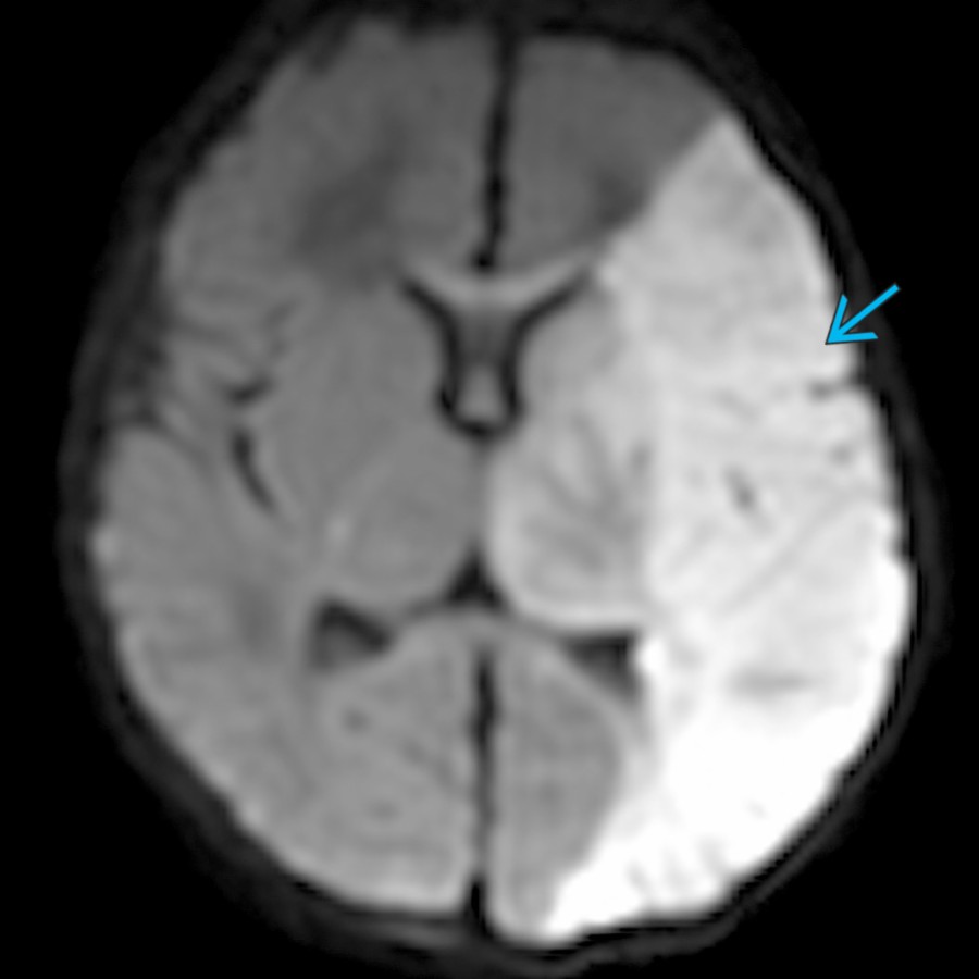 Axial DWI MR in a 4-day-old term neonate presenting with seizures shows diffusion restriction  throughout the left middle cerebral artery (MCA) territory, consistent with a perinatal arterial ischemic stroke (PAIS).