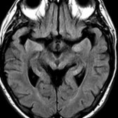 Axial FLAIR MR in the same patient shows volume loss of the midbrain with concavity of lateral margin of tegmentum , termed the "morning glory" sign, characteristic of PSP.