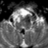 Axial T2WI MR in the same patient shows hyperintense signal in the right side of the medulla , consistent with WaD.