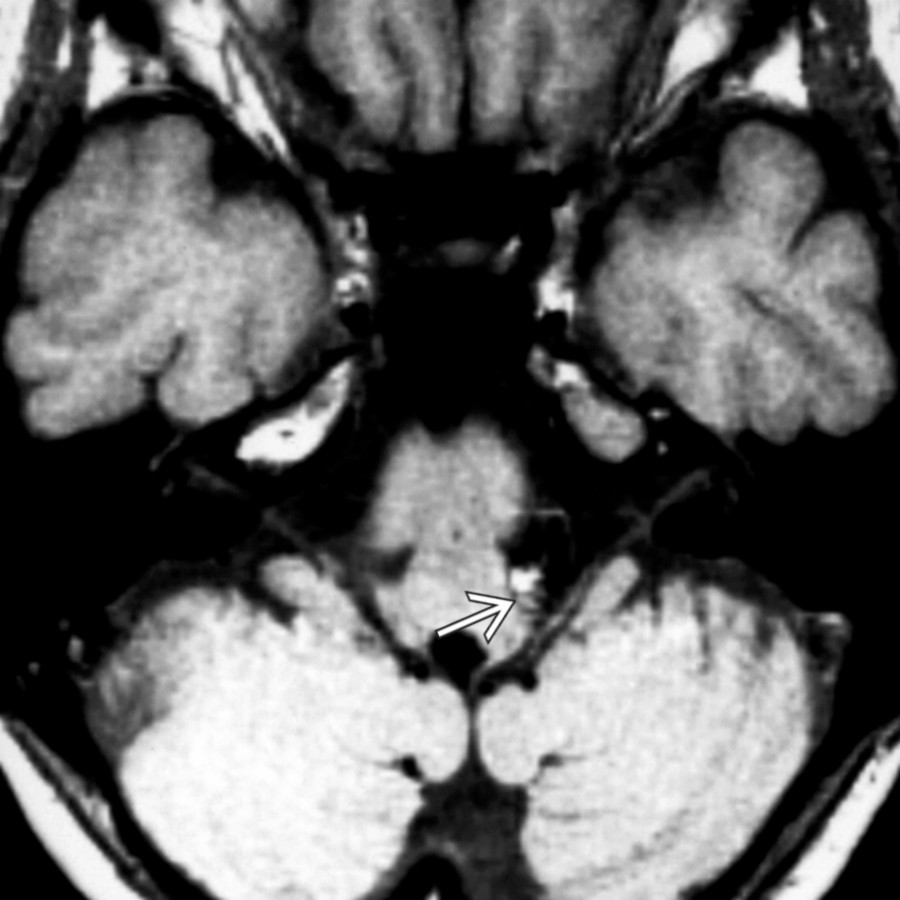 Axial T1 MR shows complex signal associated with a vertebral artery aneurysm . The aneurysm is wedged into the medial CPA cistern in the immediate vicinity of the CNVII root exit zone.