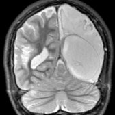 Coronal T2 MR in a victim of remote abusive head trauma now with seizures shows extensive areas of encephalomalacia  , greater on the left.  Any pathology leading to injury of the cortex puts a patient at risk for development of seizures.