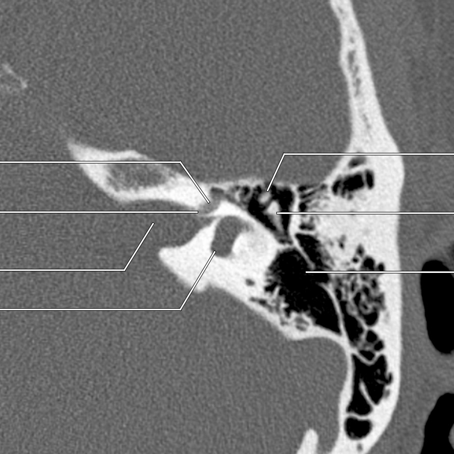 First of 6 axial bone CT of the left temporal bone presented from superior to inferior shows the labyrinthine segment of the facial nerve canal as a C-shaped structure arching anterolaterally over the top of the cochlea.