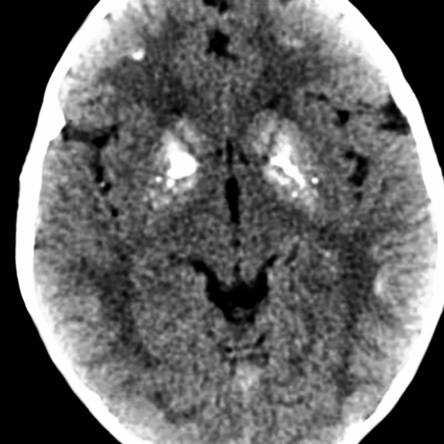 Axial NECT shows symmetric BG calcification with scattered foci of subcortical calcification. Note the typical HIV involvement of the lentiform nuclei is greater than the caudate heads.