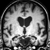 Coronal T1WI MR in a patient with Alzheimer disease (AD) shows marked hippocampal volume loss  & relative sparing of frontal lobes. (Courtesy M. J. Firbank, MD & J. T. O'Brien, MD.)