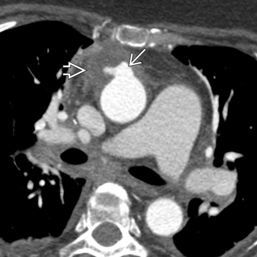 Axial CTA of the thoracic aorta shows a focal, eccentric pseudoaneurysm  arising from the anterior wall of the ascending aorta with associated periaortic soft tissue .