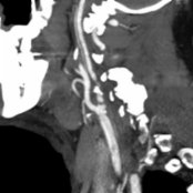 Sagittal reformat CTA shows irregularity and focal high-grade stenosis of the proximal internal carotid artery (ICA) , typical of atherosclerotic disease. Note areas of calcified plaque , which indicate an atherosclerotic etiology.