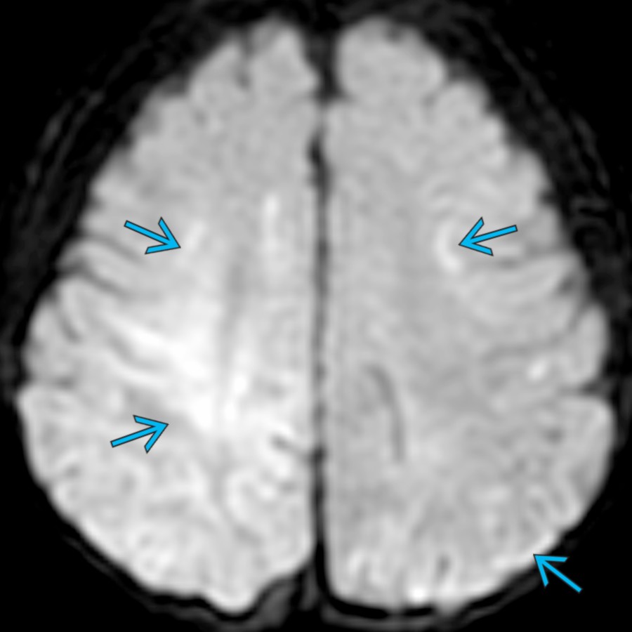 Axial DWI MR in the same patient performed 3 days after presentation shows asymmetric (right > left) diffusion restriction , consistent with brain parenchymal injury. MR is the best exam for detection & characterization of brain injury in accidental head trauma.
