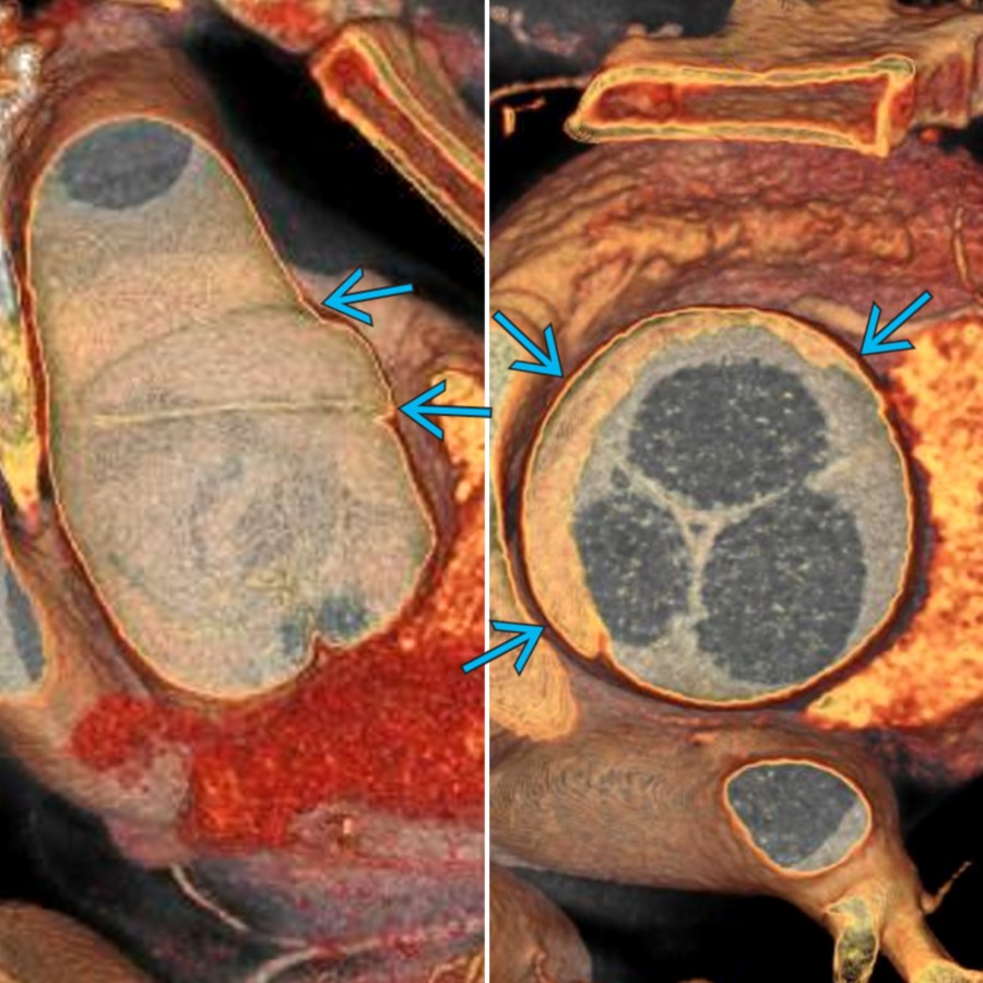 Inner/luminal view of a semicircumferential LIT  in the ascending aorta is shown. Note that the tear is stretched open in vivo (left). The edge of the tear is viewed from above (right).