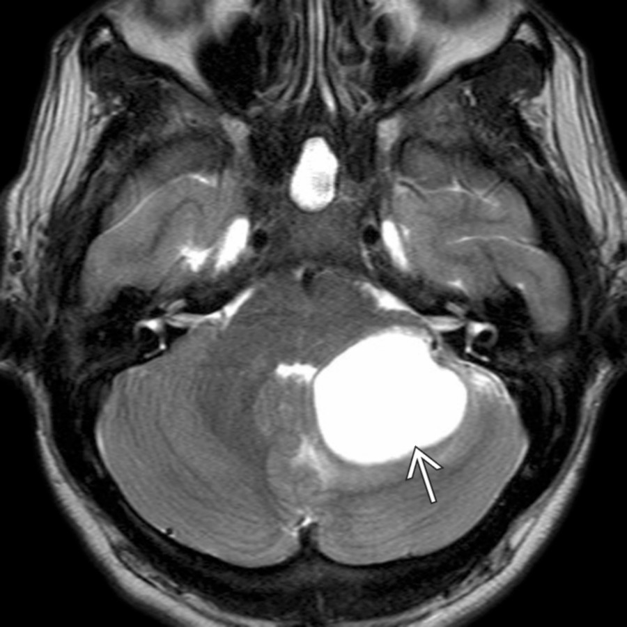 Axial T2WI MR reveals an intracerebellar high signal hemangioblastoma  projecting into the CPA cistern area. Contrast is required to define enhancing nodule if present.