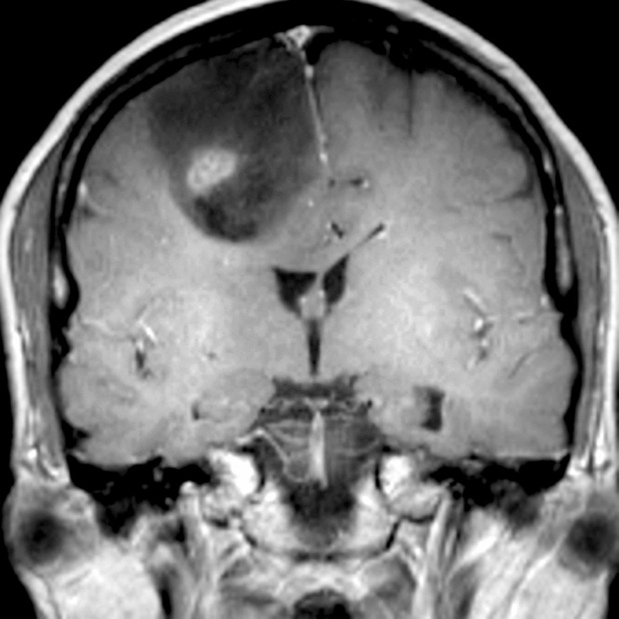 Coronal T1 C+ MR shows central heterogeneous enhancement of a low- intensity tumor involving the cortex of the posterior frontal lobe, consistent with oligodendroglioma.